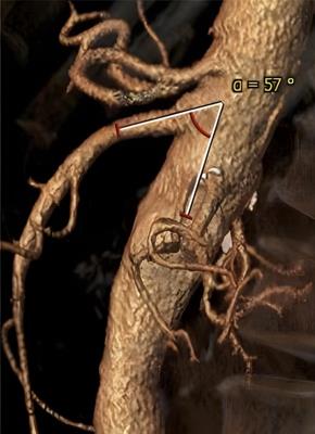 Superior mesenteric artery-related outcomes in fenestrated/branched endografting for complex aortic aneurysms